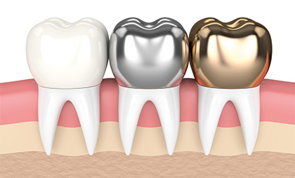 Dental Crowns 6