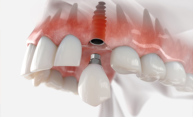 Dental Implants 01