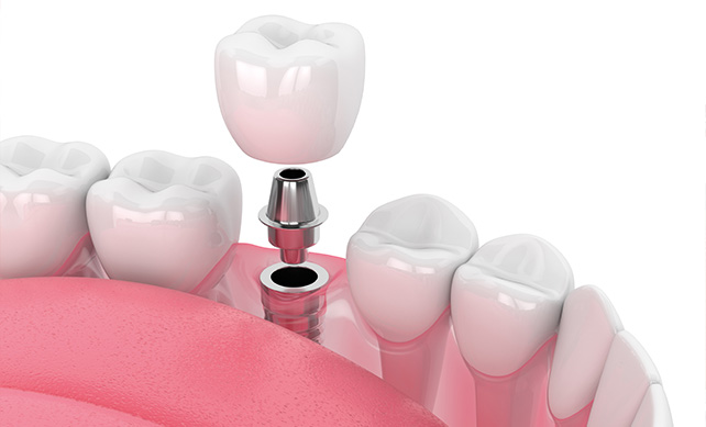 Dental Implants 03