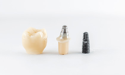 Dental Implants 05