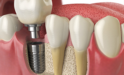 Dental Implants 06