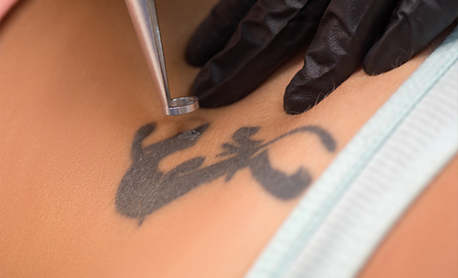 Laser Tattoo Removal-01