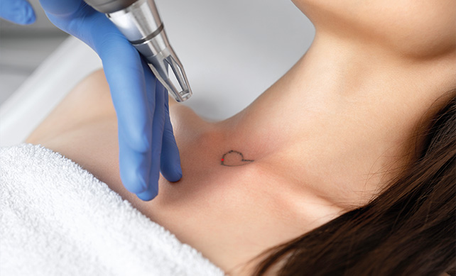 Laser Tattoo Removal 03