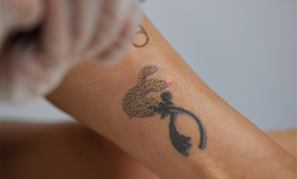 Laser Tattoo Removal 05