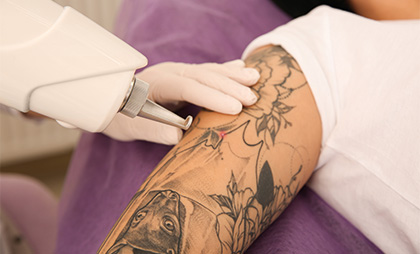 Laser Tattoo Removal 07