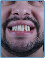 Comment sont réalisés les implants dentaires ? Turkeyana