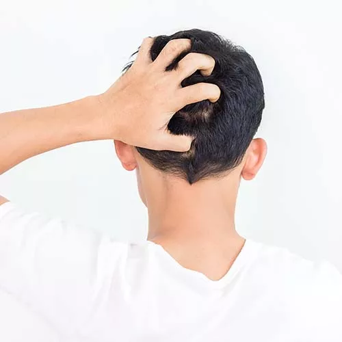 Don't let Tinea Capitis steal your hair! - Hair Transplant
