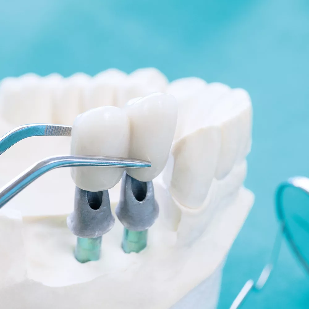 https://turkeyanaclinic.com/wp-content/uploads/2023/12/Dental-55-jpg.webp