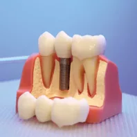Dental implant 47