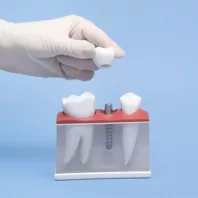 Dental implants 99